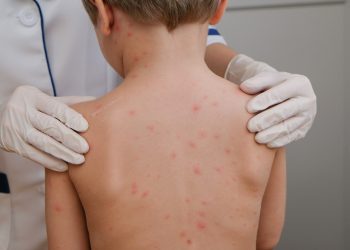 Casos de sarampión en Guatemala