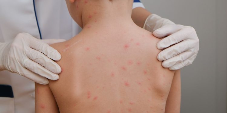 Casos de sarampión en Guatemala