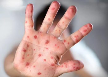 Aumento de casos de sarampión preocupa a autoridades de salud