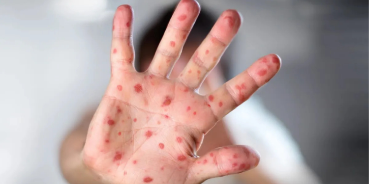 Aumento de casos de sarampión preocupa a autoridades de salud