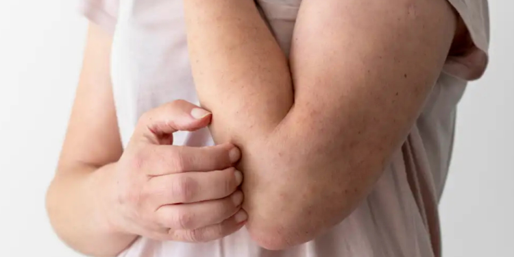 Sarampión preocupa por nuevas muertes